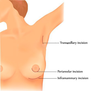 Cirurgia de implantes de silicone